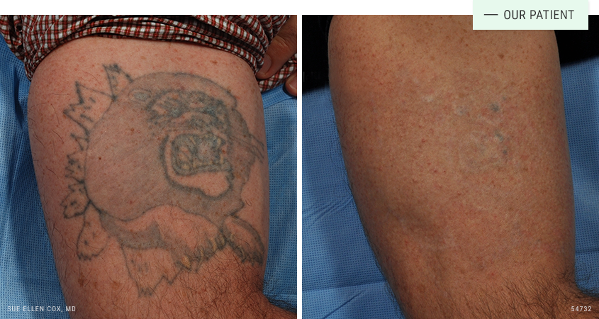 MY LASER TATTOO REMOVAL RESULTS  Tattoo Removal on Dark Skin  YouTube