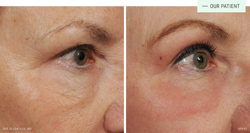 Vene Mitte Vernachl Ssigen Under Eye Fractional Laser Nord Begeisterung