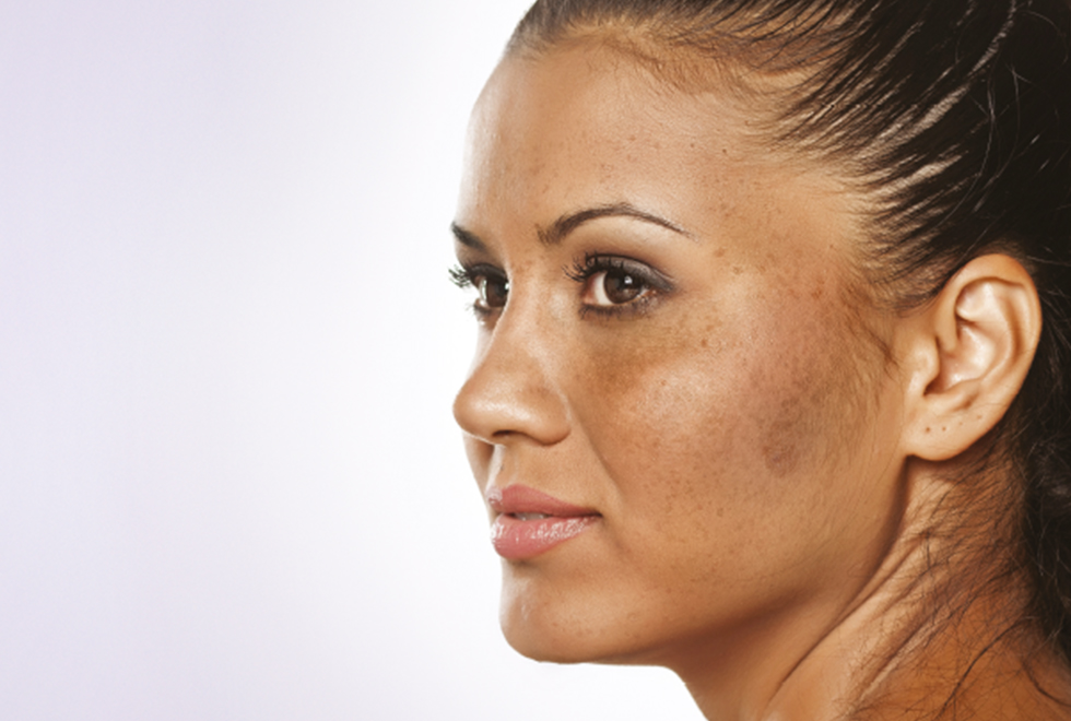 Woman with melasma