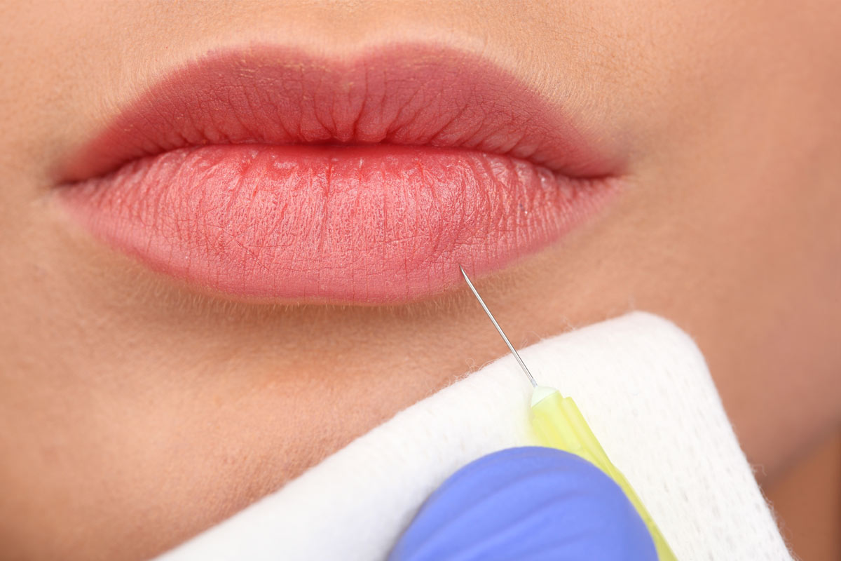 Aesthetic Solutions in Chapel Hill, NC helps their patients achieve natural looking lips with lip filler.