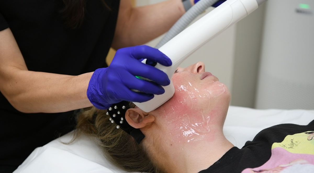 Sofwave a focused ultrasound treatment at Aesthetic Solutions can help stimulate collagen and elastin to lift the face and neck area.