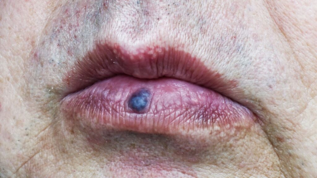 Venous Lake: What’s This Blue Spot on My Lip, and How Do I Treat It ...