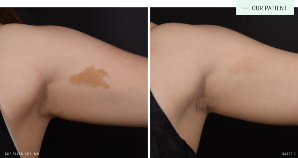 Before and After Café Au Lait Treatment