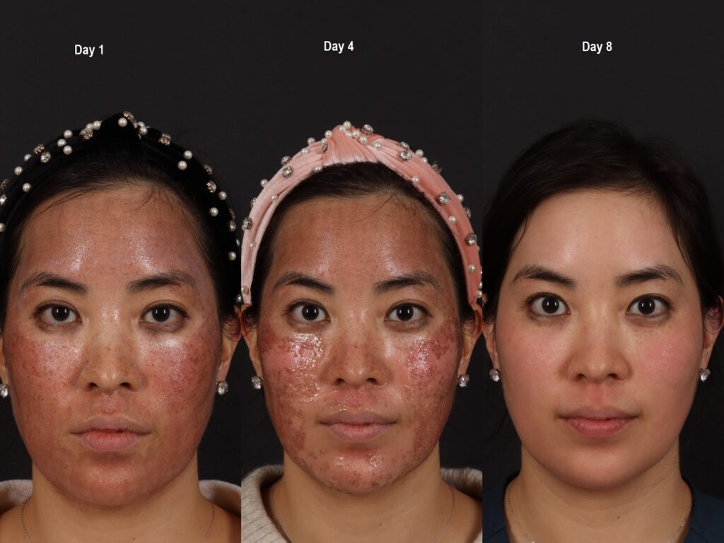 Fraxel Treatment recovery and results demonstrated.