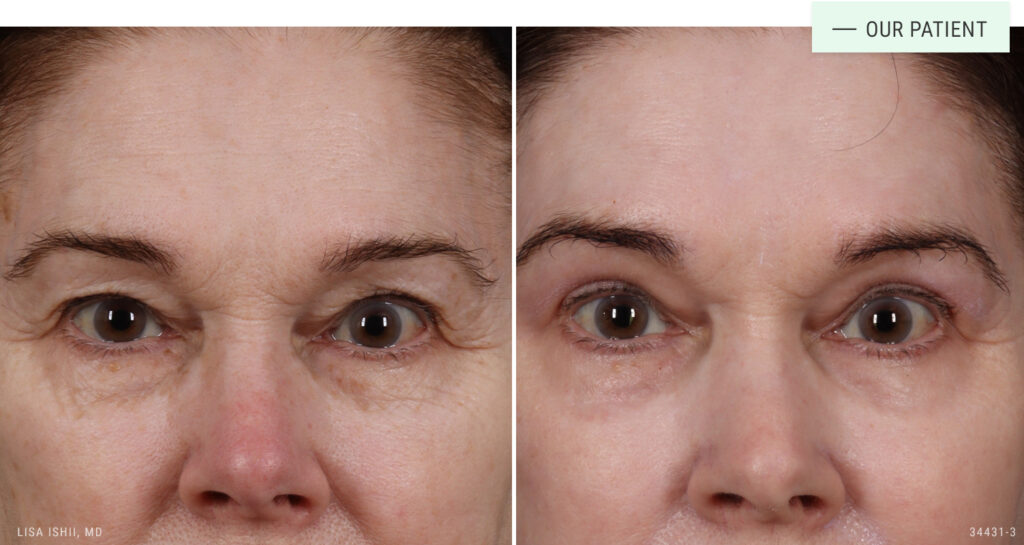 Hooded Eye Before and After Treatment
