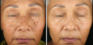 PicoSure Pro Before and After Treatment