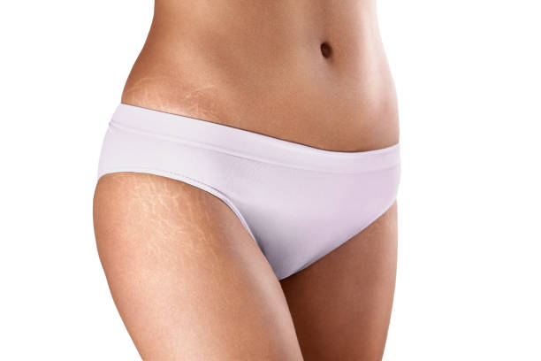Treatment for Stretch Marks - Chapel Hill, NC