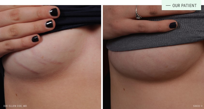 Stretch marks before and after treatment at Aesthetic Solutions.